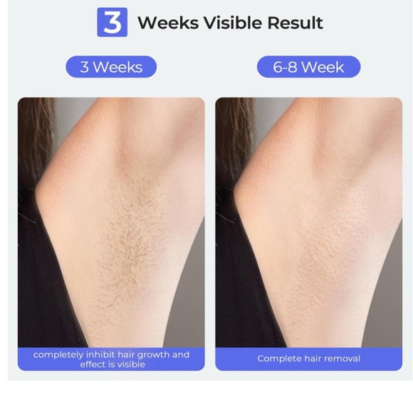 LUBEX Painless Sapphire Ice Cooling IPL Laser Hair Removal Device - Picture 3 of 10